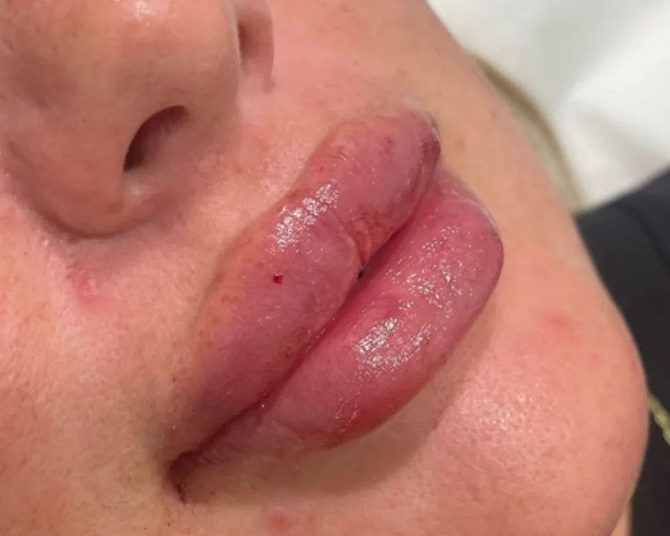 Dermal Fillers AW Vancouver