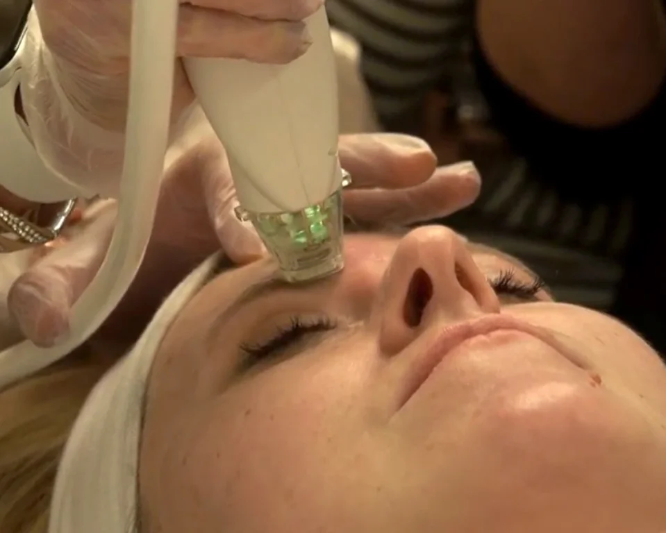 Microneedling AW Vancouver