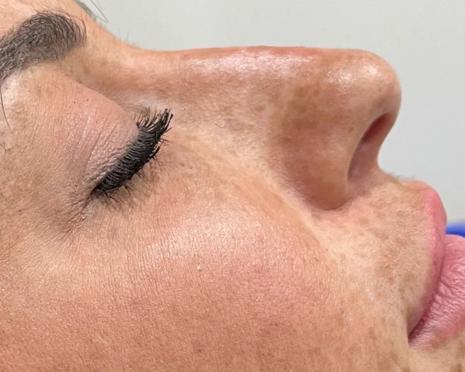 Non Surgical Facelift Rejuvenation AW