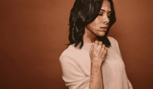 Qswtich Pigmentation uneven skin tone