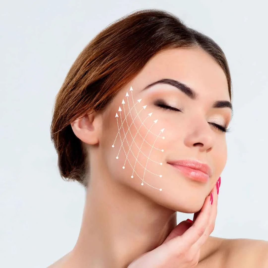 thread lift Cheeks 1